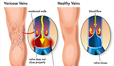 The main role of Diosmin